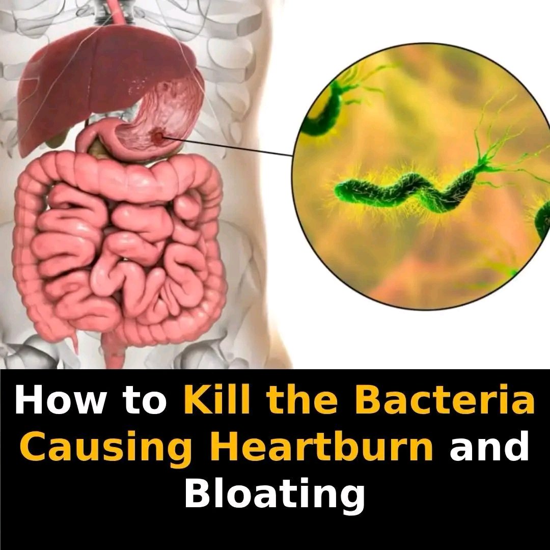 How to treat H. Pylori Bacteria Causing Heartburn And Bloating + Natural Remedies 25 1761513749297