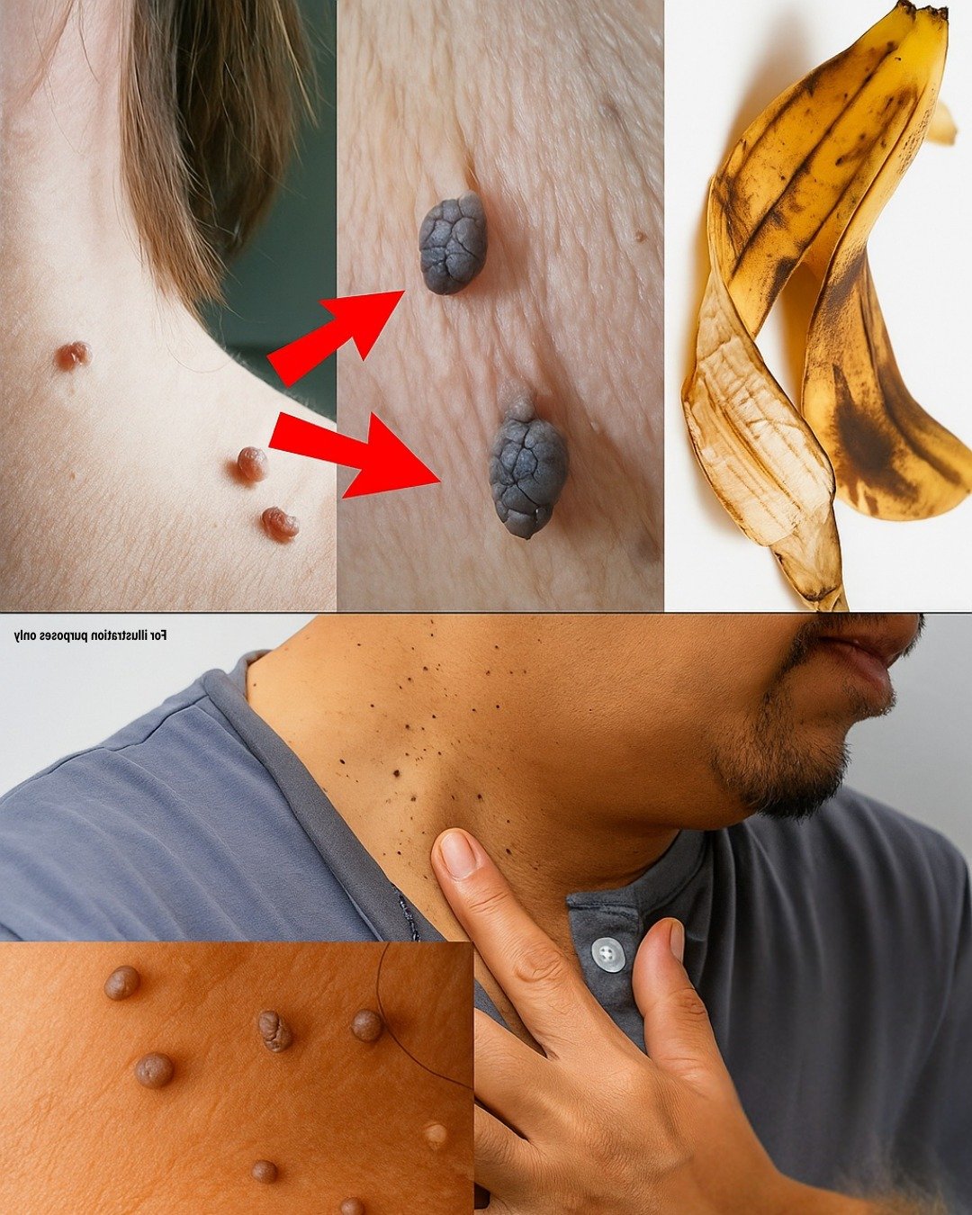 Easy and quick home remedies to get rid of skin growths in just one night… 25 514884077 740029468603437 882054 1