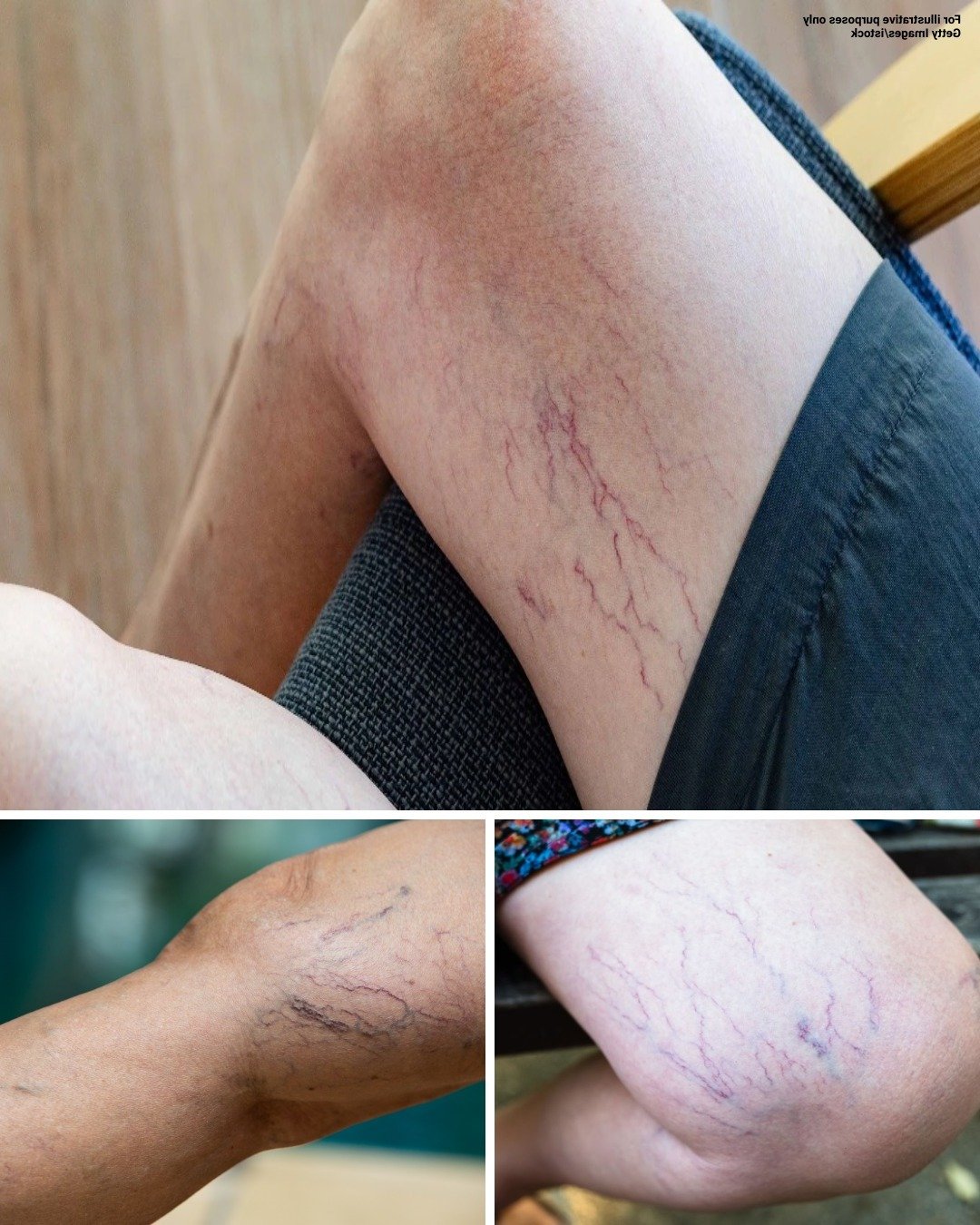 If you have purple veins on your legs, it means you are… 25 539872579 1111778234383064 19640 1