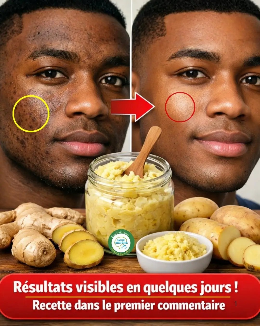 # Incroyable ! En seulement 20 minutes, IL a effacé les taches et les imperfections du visage avec de la pomme de terre et du gingembre. LA RECETTE DU MÉLANGE ET LA FAÇON DE L’UTILISER que j’ai laissées dans le premier commentaire. Il vous suffit de commenter « OK » pour recevoir la recette. 25 1782080655890