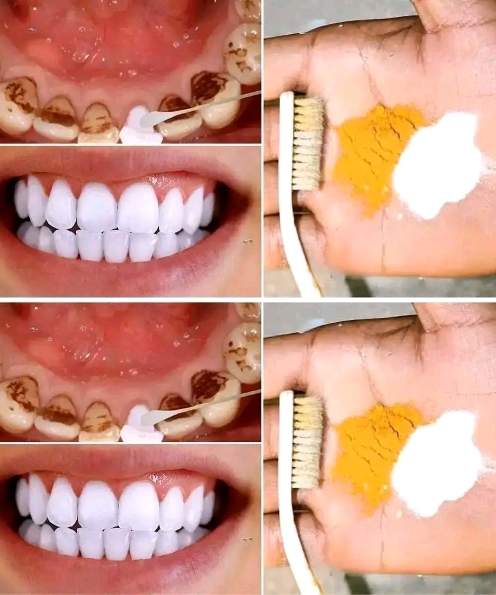 À la maison : des dents plus blanches en seulement 2 minutes !… Recette dans les commentaires. ⤵ Si vous souhaitez suivre mes recettes, écrivez « oui » ❤️ 25 1782588296198