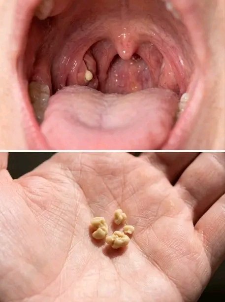 Si vous avez des petites boules blanches dans la gorge, cela peut révéler quelque chose sur votre santé… Voir plus. 25 1783437961297